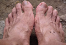 상처 감염으로 인한 고열과 통증에서 회복되고 있어