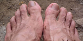 상처 감염으로 인한 고열과 통증에서 회복되고 있어