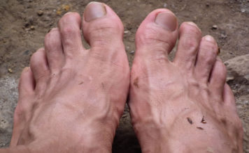 상처 감염으로 인한 고열과 통증에서 회복되고 있어